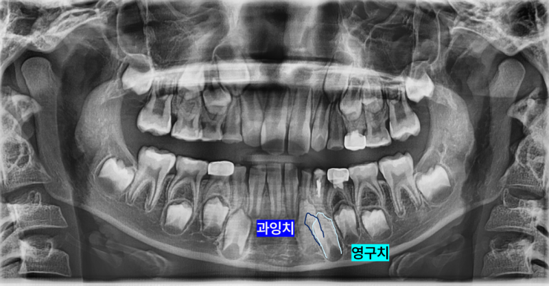 어린이 파노라마 방사선 사진에서 하악 좌측 영구치와 과잉치가 표시된 이미지