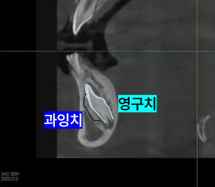 CT 촬영 사진에서 하악 좌측 영구치와 과잉치가 측면에서 보이는 이미지