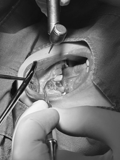 어린이 환자의 구강 내에서 과잉치 제거 후 치조골이 노출된 임상 사진
