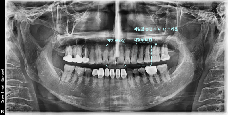 오래된 크라운, 앞니 충치, 교합면 충치 및 레진 탈락, 치경부 착색이 표시된 파노라마 방사선 사진