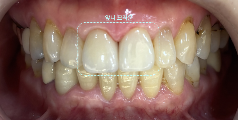 PFZ 크라운, 치경부 레진, 이마갈륨 충전 후 PFM 크라운이 표시된 파노라마 방사선 사진
