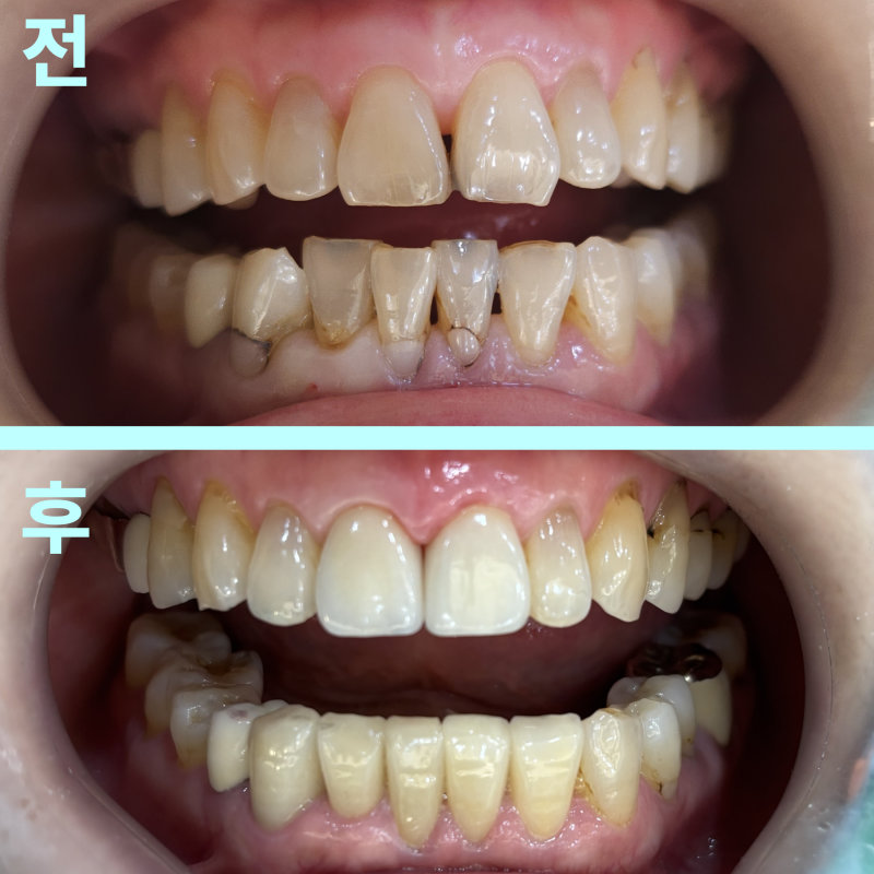 앞니 크라운이 표시된 상악 전치부 임상 사진