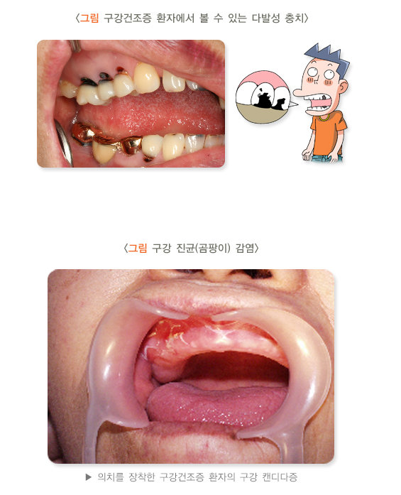 구강건조증 환자의 다발성 충치와 침 마르면 충치가 많이 생기는 이유를 설명하는 일러스트