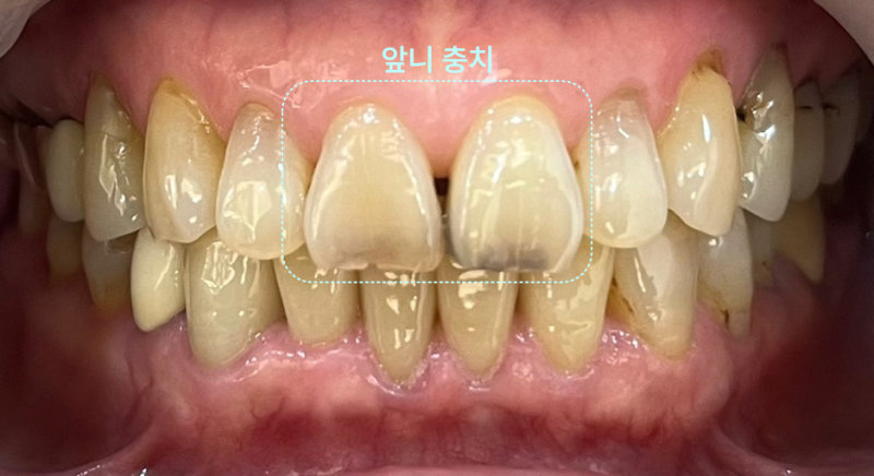 앞니 크라운이 표시된 하악 전치부 임상 사진