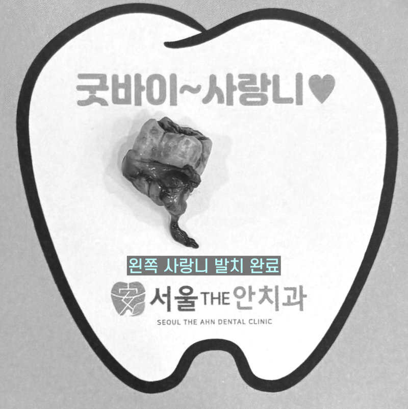 치아 모양의 종이 위에 발치된 왼쪽 사랑니가 놓여 있고 '굿바이~사랑니' 문구가 있는 사진