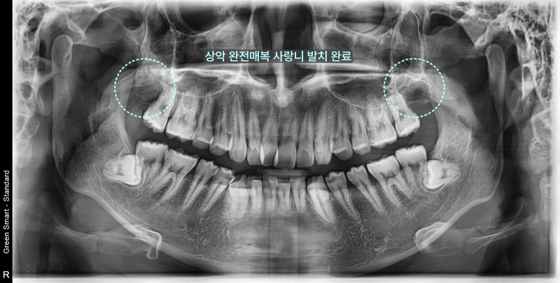 상악 양측 완전 매복 사랑니 발치 후 빈 공간을 점선 원으로 표시한 파노라마 방사선 사진