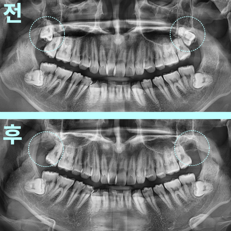 상악 양측 매복 사랑니 발치 전후를 비교하는 파노라마 방사선 사진 두 장