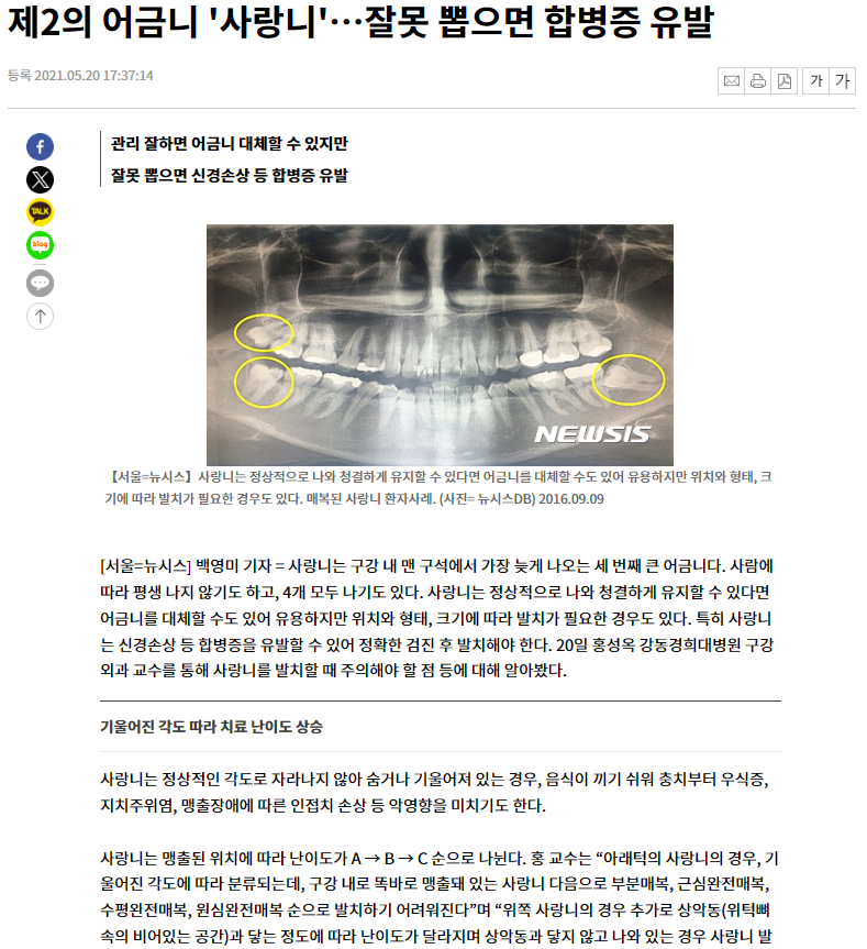 뉴스 기사 본문 중 하악 양측 매복 사랑니를 노란색 원으로 표시한 파노라마 방사선 사진