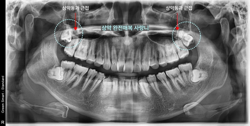 상악 양측 완전 매복 사랑니와 상악동 근접 부위를 점선 원과 화살표로 표시한 파노라마 방사선 사진
