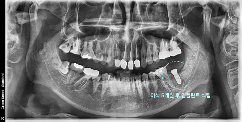 파노라마 방사선 사진에서 하악 좌측 발치 후 5개월 뒤 임플란트 식립