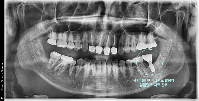 파노라마 방사선 사진에서 사랑니 뼈이식재를 활용한 임플란트 치료 완료