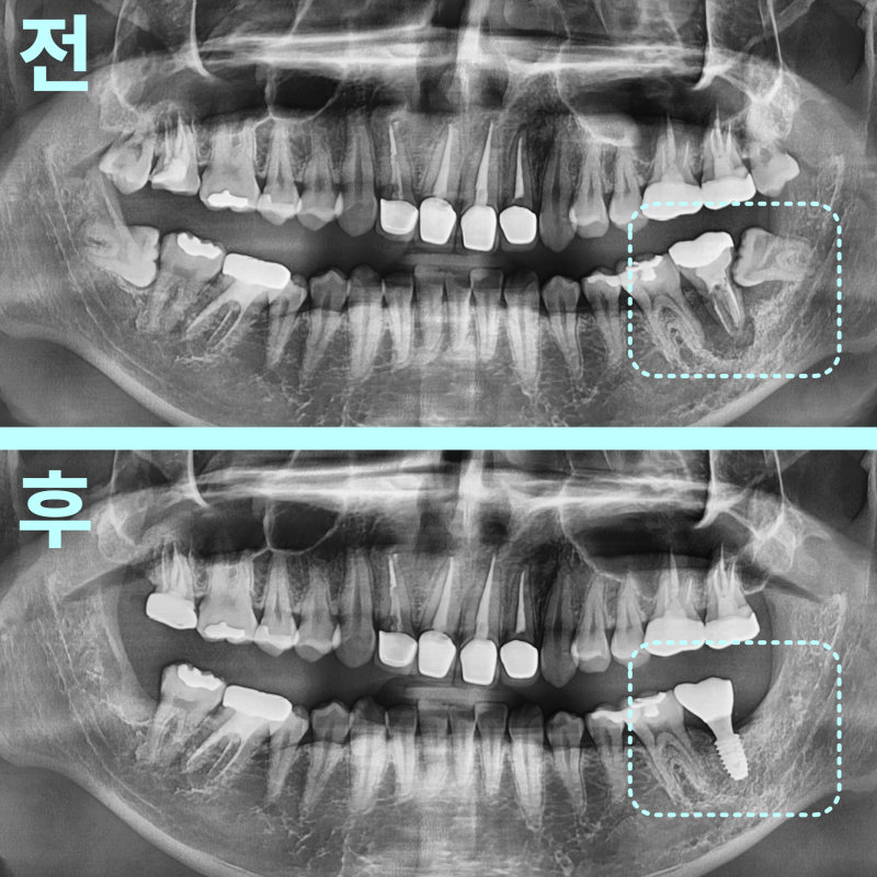 치료 전후 파노라마 방사선 사진 비교