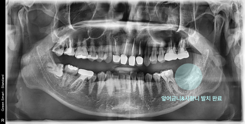 파노라마 방사선 사진에서 하악 좌측 앞 어금니 및 사랑니 발치 완료