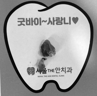 발치된 사랑니 2개를 보여주는 '굿바이~사랑니' 문구가 있는 종이