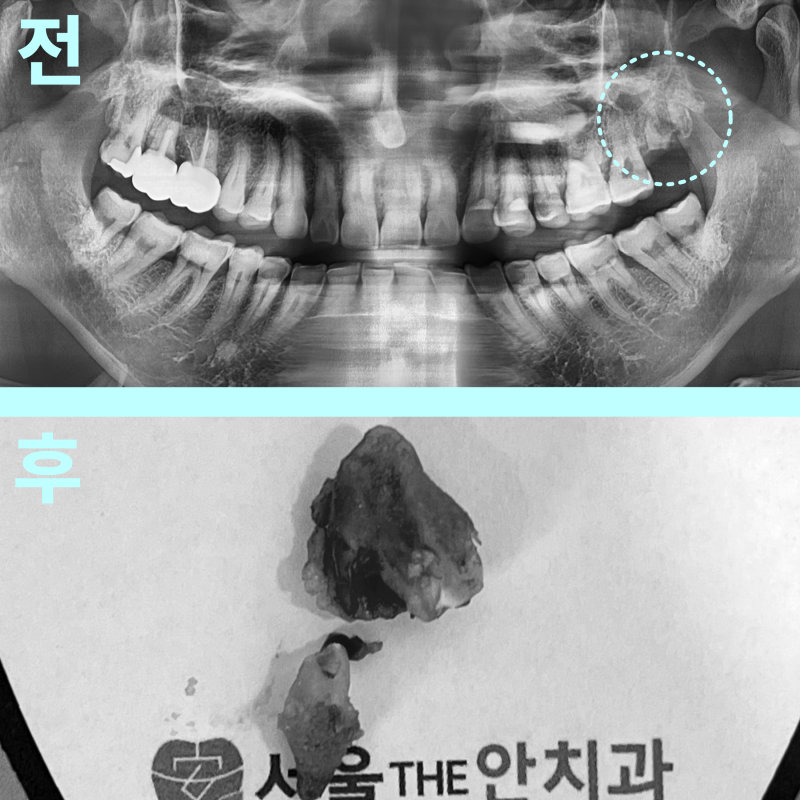 상악동에 근접한 매복 사랑니 발치 전후를 보여주는 파노라마 방사선 사진과 발치된 사랑니
