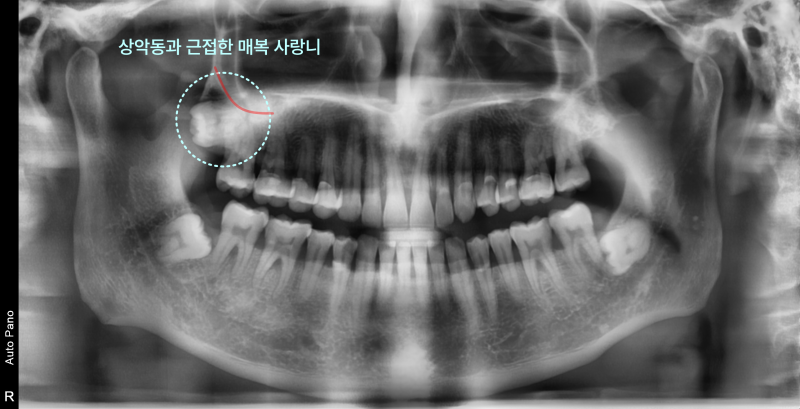 상악동과 근접한 매복 사랑니를 보여주는 파노라마 방사선 사진