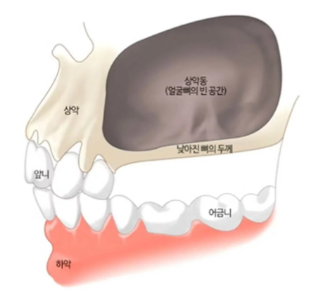 상악동과 치아의 해부학적 구조를 설명하는 그림