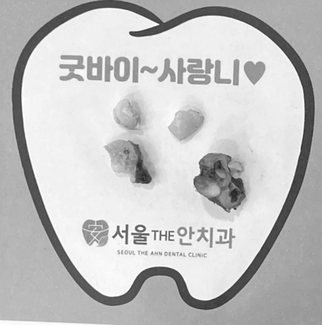 발치된 사랑니 4개를 보여주는 '굿바이~사랑니' 문구가 있는 종이