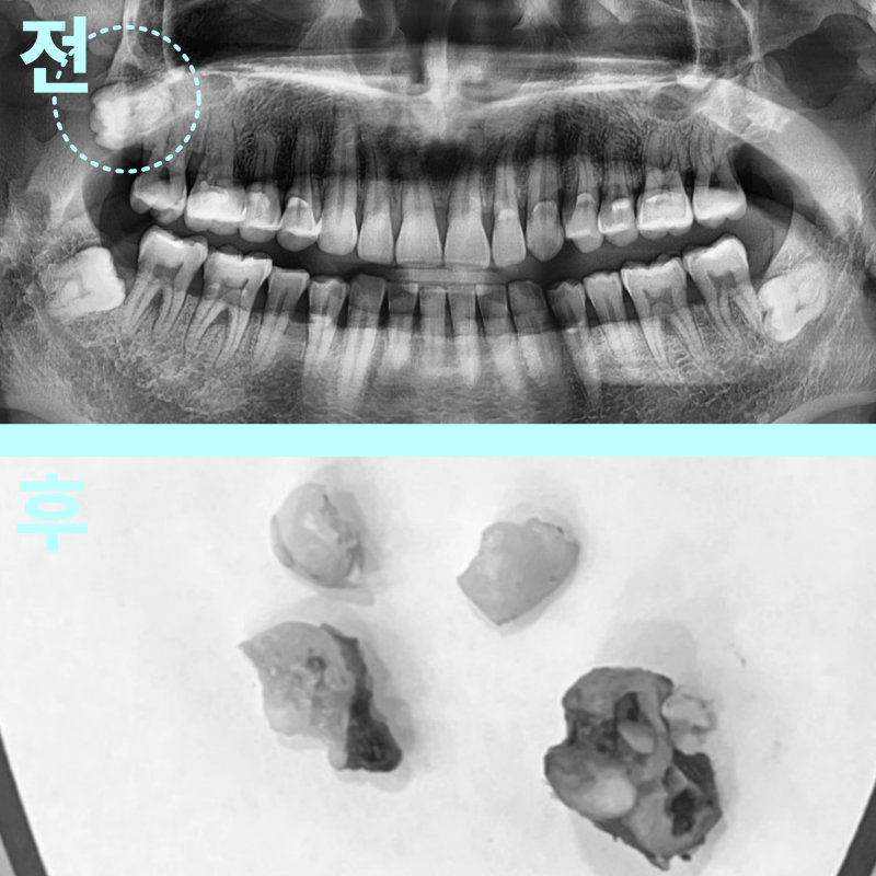상악동과 근접한 매복 사랑니 발치 전후를 보여주는 파노라마 방사선 사진과 발치된 사랑니