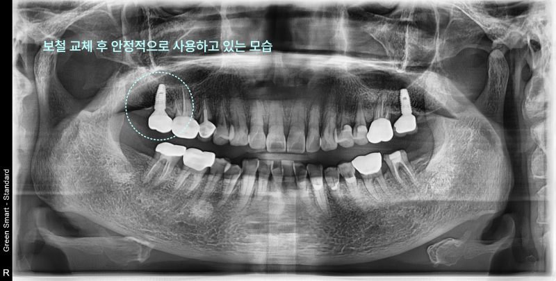 태전동치과 타 치과 임플란트 보철만 바꿔도 될까요? 9 보철 교체 후 안정적으로 사용 중인 좌측 상악 어금니 임플란트 파노라마 방사선 사진