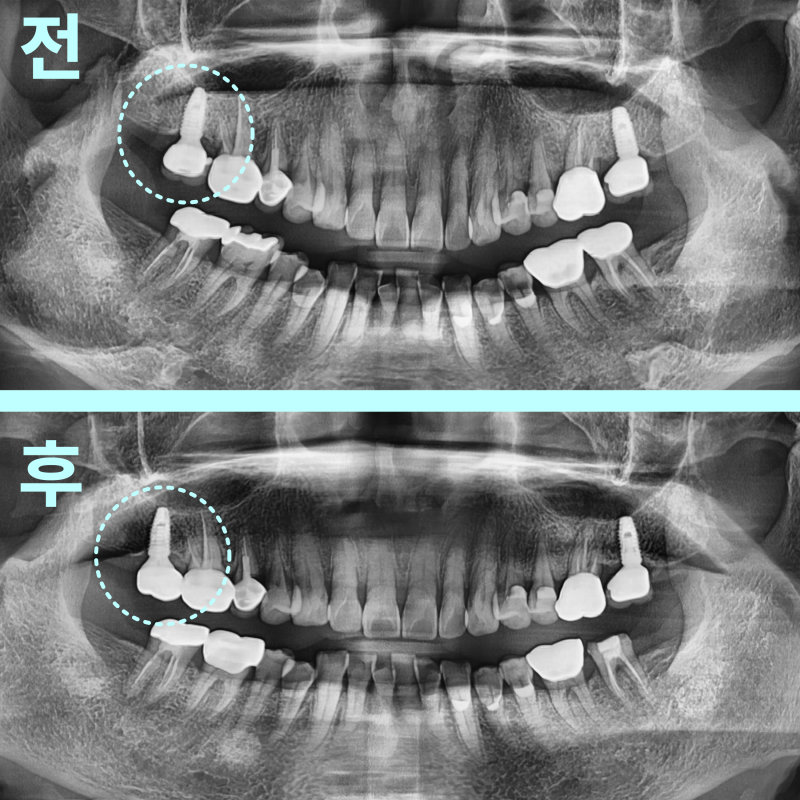 태전동치과 타 치과 임플란트 보철만 바꿔도 될까요? 10 좌측 상악 어금니 임플란트 보철 교체 전후를 비교하는 파노라마 방사선 사진