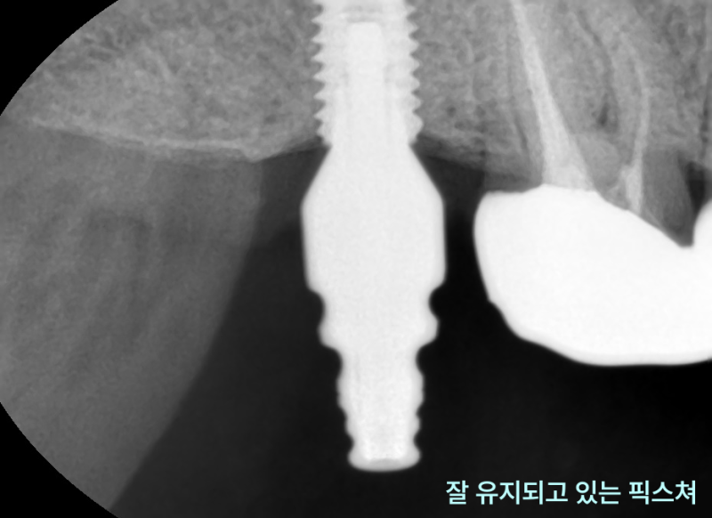 태전동치과 타 치과 임플란트 보철만 바꿔도 될까요? 3 좌측 상악 어금니 임플란트 픽스처가 잘 유지되고 있는 치근단 방사선 사진