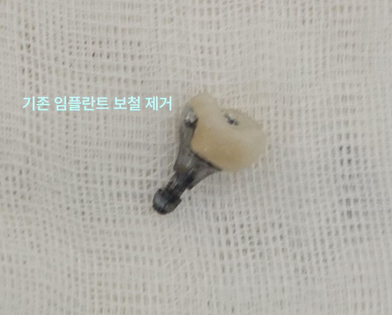 태전동치과 타 치과 임플란트 보철만 바꿔도 될까요? 6 흰색 천 위에 놓인 기존 임플란트 보철물의 근접 사진