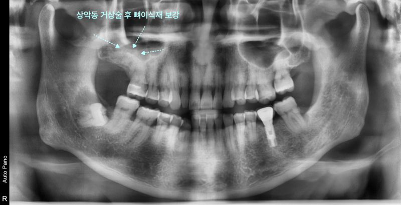 경기광주치과 부러진 임플란트, 재수술도 가능할까요? 10 파노라마 방사선 사진에서 상악동 거상술 후 뼈 이식재가 보강된 부위를 표시한 모습
