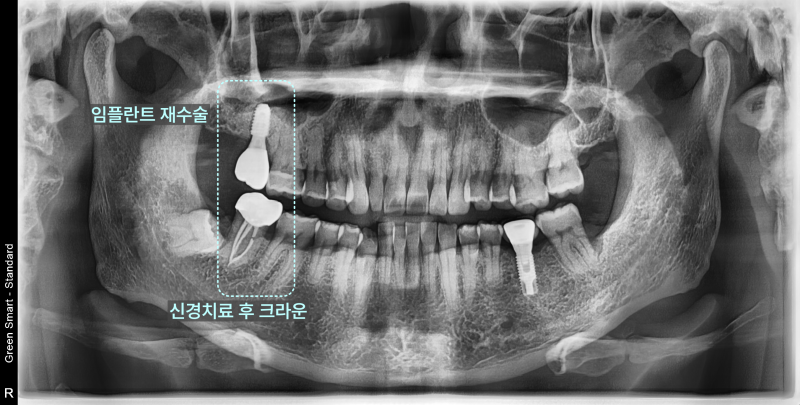 경기광주치과 부러진 임플란트, 재수술도 가능할까요? 15 파노라마 방사선 사진에서 임플란트 재수술 부위와 신경치료 후 크라운 부위를 표시한 모습