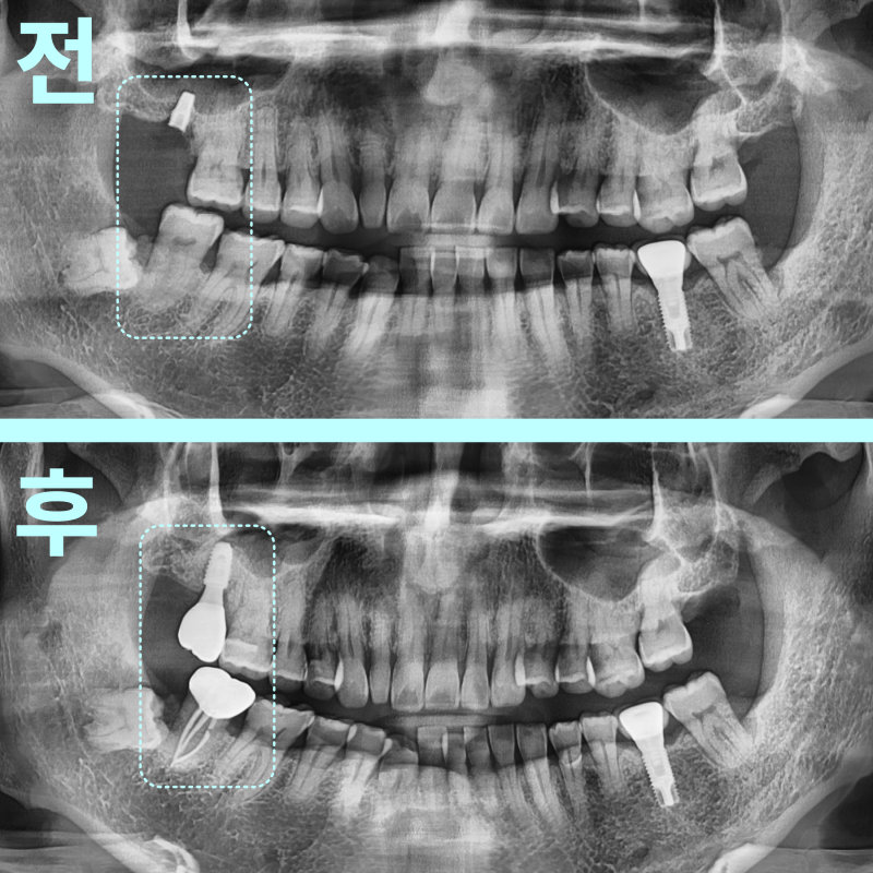 경기광주치과 부러진 임플란트, 재수술도 가능할까요? 17 임플란트 재수술 전후를 비교하는 파노라마 방사선 사진