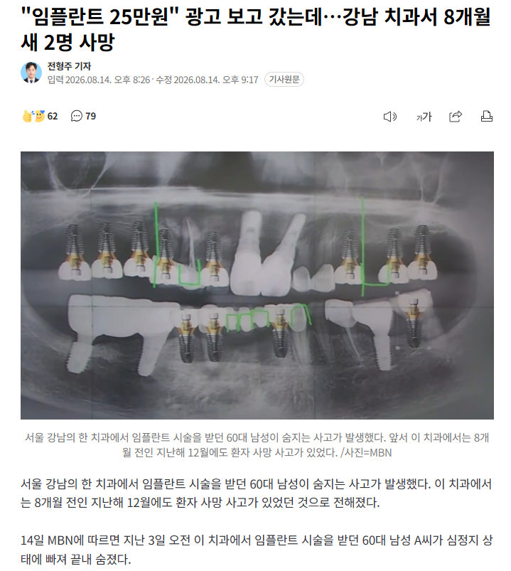치과 임플란트 시술 후 전체 파노라마 방사선 사진
