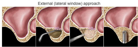 경기광주치과 부러진 임플란트, 재수술도 가능할까요? 5 상악동 거상술(External lateral window approach) 과정을 보여주는 4단계 삽화