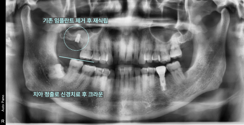 경기광주치과 부러진 임플란트, 재수술도 가능할까요? 6 파노라마 방사선 사진에서 기존 임플란트 제거 및 재식립, 치아 정출 후 신경치료 및 크라운 계획을 표시한 모습