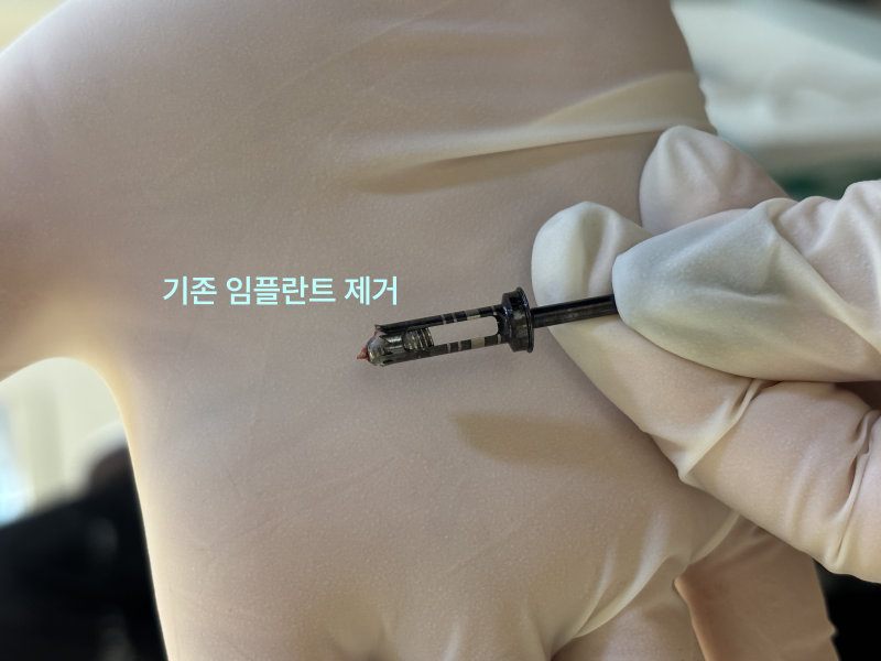 경기광주치과 부러진 임플란트, 재수술도 가능할까요? 7 의료용 장갑을 낀 손이 제거된 기존 임플란트를 잡고 있는 근접 사진