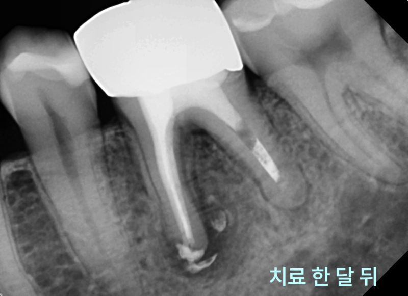 하악 좌측 어금니 재신경치료 한 달 후 치근단 방사선 사진