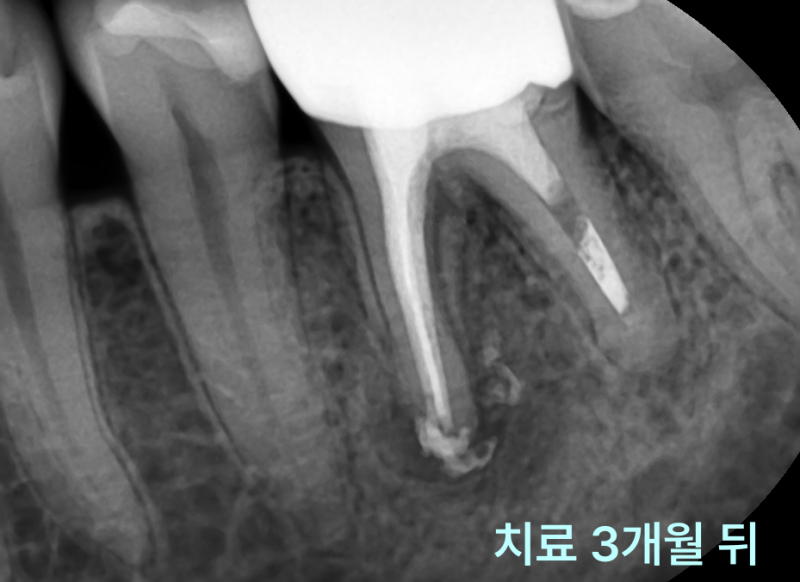 하악 좌측 어금니 재신경치료 3개월 후 치근단 방사선 사진