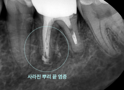 하악 좌측 어금니 재신경치료 3개월 후 뿌리 끝 염증이 사라진 치근단 방사선 사진