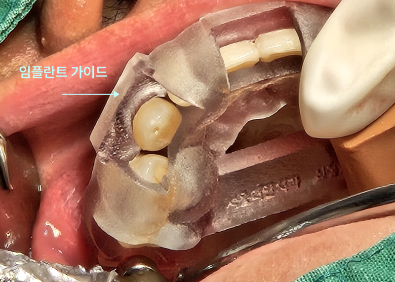 임플란트 가이드를 이용해 수술 중인 환자 입