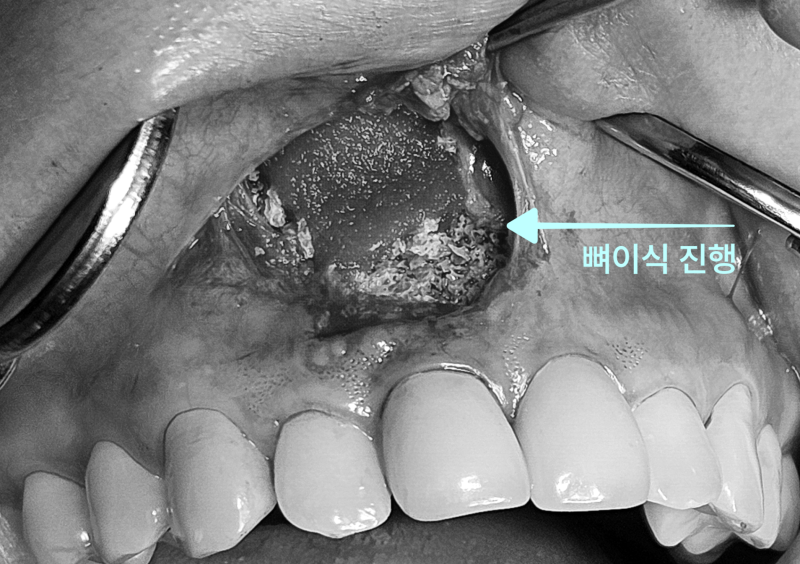 “이건 빼야겠네요”라는 말, 정말 끝일까요? 경기광주치과 자연치아 살리기 위한 의사의 고민