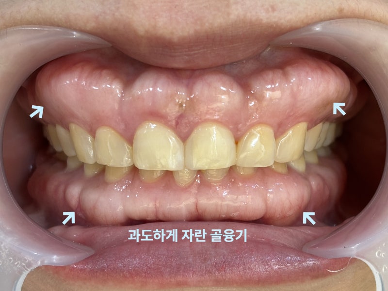 과도하게 자란 잇몸뼈가 화살표로 표시됨