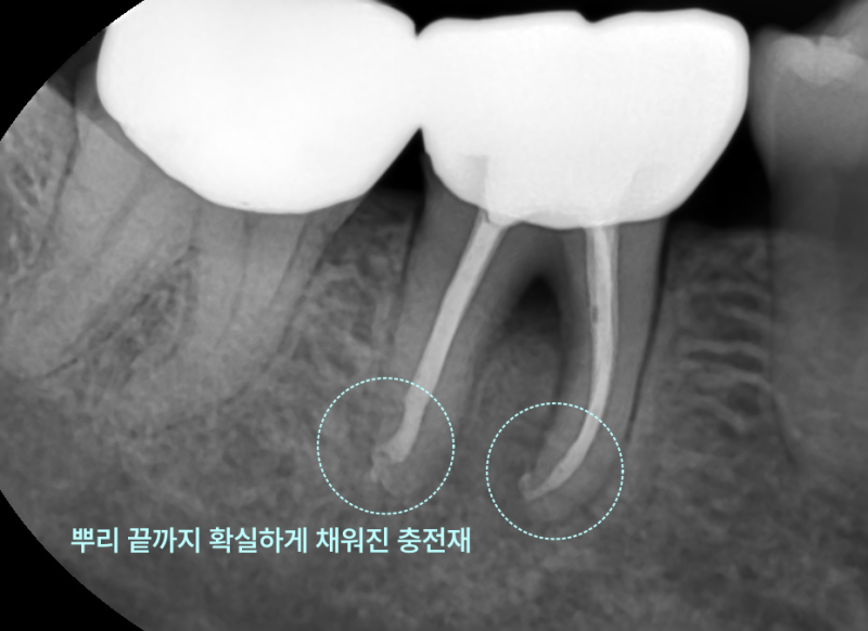 “안 아파서 괜찮은 줄 알았어요” 곤지암치과, 정기 검진 미뤘다가 신경치료한 사례