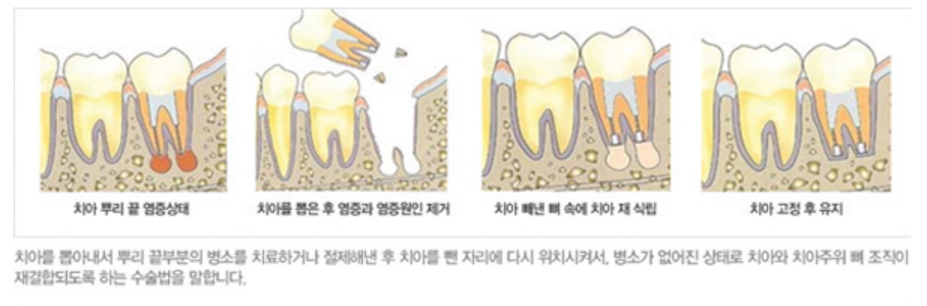 경기광주치과 “빼야 할 것 같아요” 진단받은 어금니, 의도적 재식술로 살린 이야기 5 치아 재식술 과정을 설명하는 그림