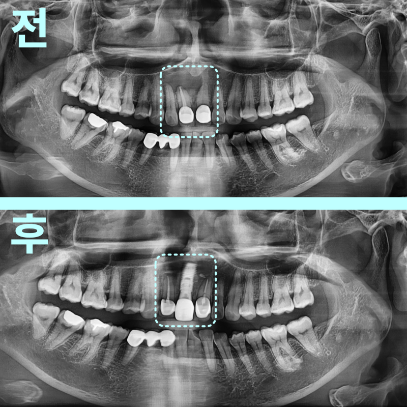 “이건 빼야겠네요”라는 말, 정말 끝일까요? 경기광주치과 자연치아 살리기 위한 의사의 고민