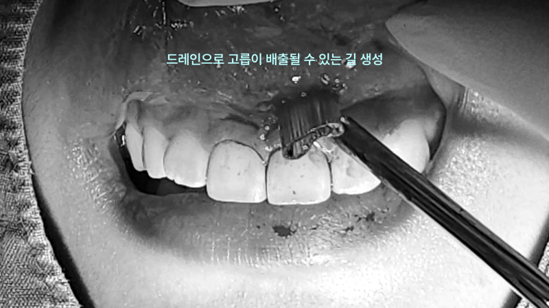 “신경치료까지 했는데 왜 또 붓죠?” 앞니 잇몸 염증, 원인부터 잡아야 합니다. 8 드레인으로 고름이 배출되는 길을 만드는 수술 장면