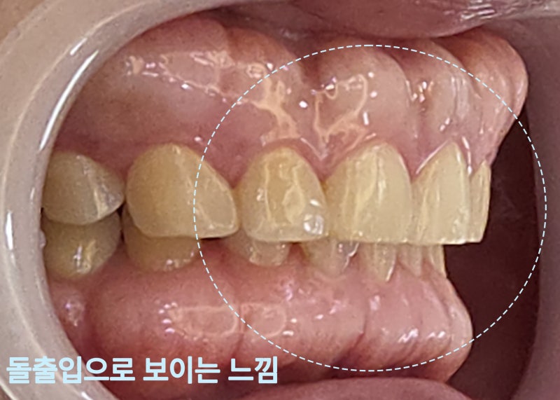 돌출입으로 보이는 치아와 잇몸