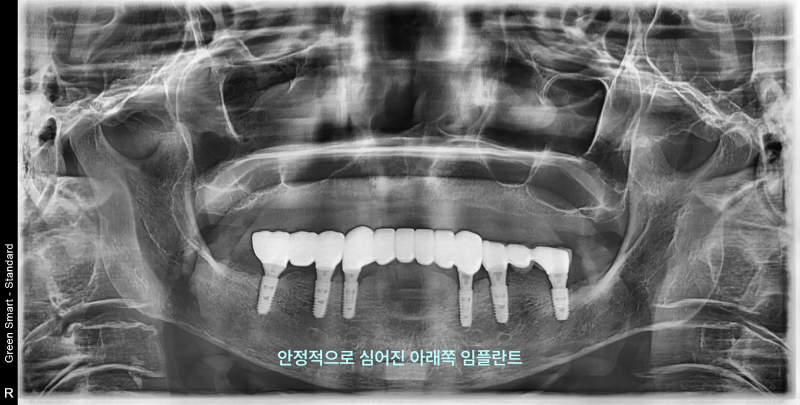 태전동치과 임플란트 비용, 무조건 비쌀까요? 현명하게 줄이는 법