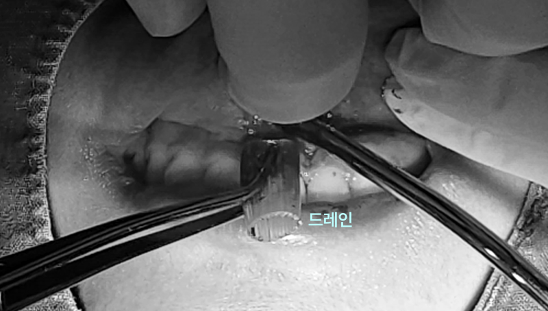 “신경치료까지 했는데 왜 또 붓죠?” 앞니 잇몸 염증, 원인부터 잡아야 합니다. 7 잇몸에 드레인을 삽입하는 수술 장면
