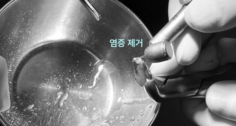 경기광주치과 “빼야 할 것 같아요” 진단받은 어금니, 의도적 재식술로 살린 이야기 7 발치된 치아의 염증을 제거하는 모습