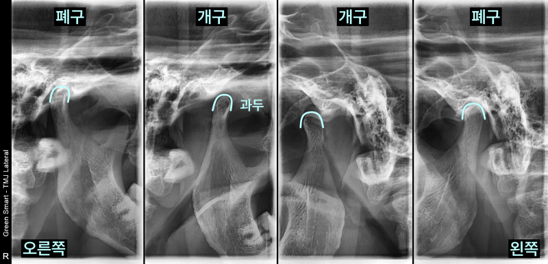 개구와 폐구 시 턱관절 움직임을 보여주는 엑스레이 사진