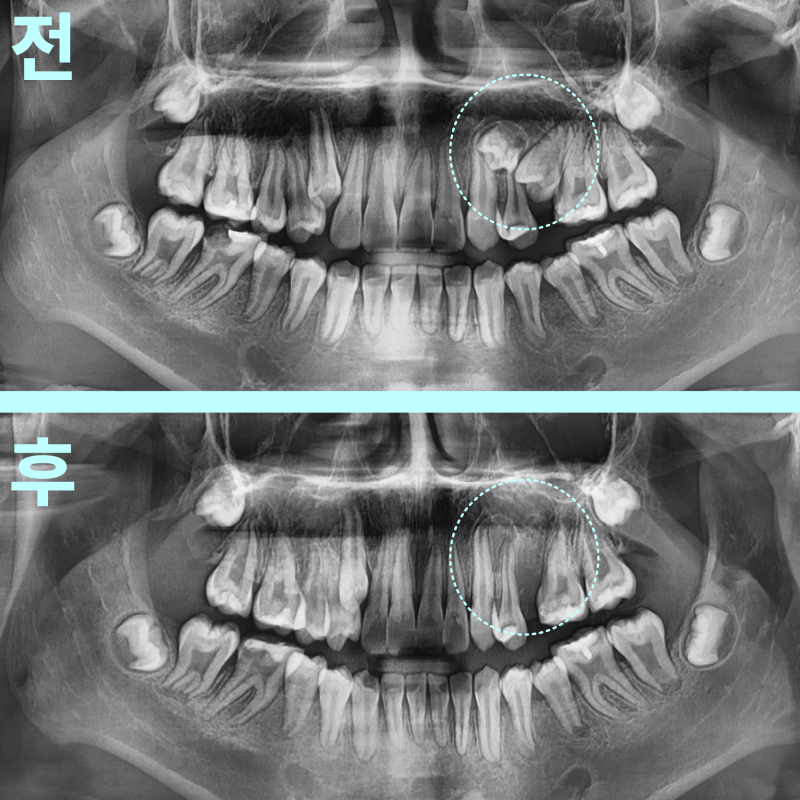 태전동치과 “아프지도 않은데 꼭 빼야 하나요?” 성장기 매복 과잉치, 구강외과 전문의에게 발치해야 하는 이유 10 “아프지도 않은데 꼭 빼야 하나요?” 성장기 매복 과잉치, 구강외과 전문의에게 발치해야 하는 이유